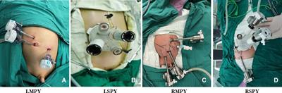 Robot-assisted pyeloplasty and laparoscopic pyeloplasty in children: A comparison of single-port-plus-one and multiport surgery